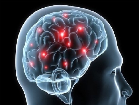 Image result for سکته مغزی