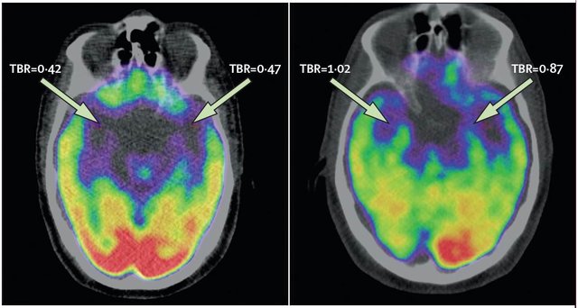 170111-brain-scan-mn-1355_727c2e57830524a767345ee6cbdc9d6b.nbcnews-ux-2880-1000.jpg