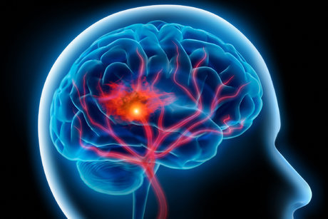 چگونه "طرح 724" بیماران سکته مغزی را نجات می‌دهد؟