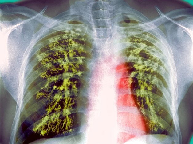 موسیر با مقاومت آنتیبیوتیکی سل مقابله میکند سل