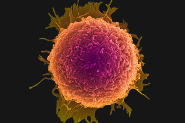تغذیه ناسالم علت بروز سرطان تغذیه ناسالم علت بروز سرطان