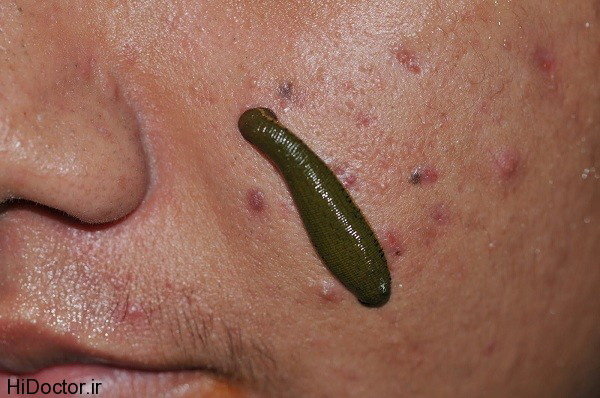 عکس تزیینی است. در زالودرمانی فقط زالوی طبی عرضه شده در داروخانهها مورد تائید است