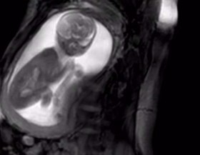 مشاهده قلب جنین انسان ممکن می‌شود+تصاویر