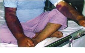 ابتلای یک نفر به تب کریمه کنگو در استان هرمزگان تب کنگو