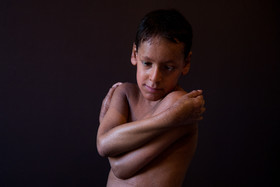 حسین ، ۱۰ ساله، به بیماری ژنتیکی ایکتیوز (Ichthyosis) (نوع خاص و شدید خشکی پوست) مبتلاست. از بدو تولد برای ادامه روند درمان و قطع امید کردن پزشکان محلی، از شهرستان ازنا (در استان لرستان) با خانوادهاش به تهران آمده است. او در کلاس چهارم دبستان تحصیل میکند. حسین آرزو دارد برای مادرش ماشین و خانه بخرد و چشمهایش زودتر خوب شود تا بتواند با دوچرخه به مدرسه برود.