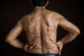 مجید، ۴۶ ساله، به بیماری ژنتیکی نوروفیبروماتوز (Neurofibromatosis) (رشد تومورهای پوستی در سیستم عصبی) مبتلاست. او دارای مدارک کارشناسی هواشناسی و کارشناسی مدیریت است. همسر مجید به خاطر بیماری او خواستار طلاق شده و چهار سال است که مجید نتوانسته با تنهایی‌اش کنار بیاید. او آرزو دارد کسی به این بیماری دچار نشود و برای پسرش هم دعا می‌کند و امیدوار است او به آرزوهایش برسد.