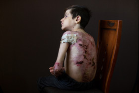 .علیرضا، ۱۷ ساله، مبتلا به بیماری ایبی (اپیدرمولیز بولوسا  - EB) است که یک بیماری ارثی است که در پوست و غشای مخاطی ایجاد تاول میکند
. علیرضا سالها با شیوههای غیرمناسب نگهداری شده و با درد زیاد زندگی کرده. علیرضا مدرسه را بهخاطر شرایط بد ترک کرده. اما مدتی است که از پانسمانهای استاندارد استفاده میکند. تنها سرگرمی او بازی یا عکس گرفتن با موبایل است. علیرضا آرزو دارد که عاقبت بخیر شود و همه مستأجرها خانهدار شوند.