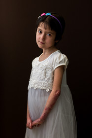 زینب، ۸ ساله، مبتلا به بیماری ایبی (اپیدرمولیز بولوسا  - EB) است که یک بیماری ارثی است،که در پوست و غشای مخاطی ایجاد تاول میکند.زینب به خاطر عدم رشد یکی از پاهایش تا ۴سالگی نمیتوانست راه برود.راه رفتن او مثل یک معجزه بود. زینب بسیار پر انرژی و باهوش است. محبت و پیگیریهای پدر و مادرش در روحیه او بسیار تأثیرگذار بوده. قرنیه چشمهای زینب بر اثر عوارض داروها با مشکل مواجه شده، شاید این مشکل تازه در تصمیم او برای آیندهاش تأثیر داشته، چون آرزو دارد چشمپزشک شود.