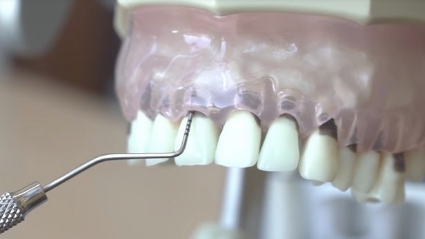 استفاده از جوهر ماهی مرکب برای بررسی سلامت لثهها
