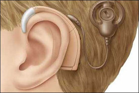 آغاز توزیع پردازشگر شنوایی برای ۲۶۰۰ بیمار نیازمند