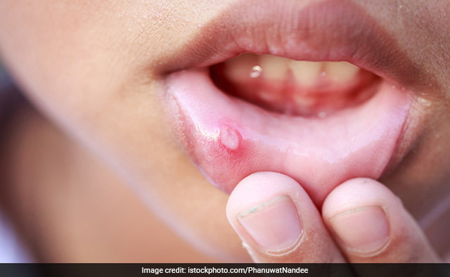 ۷ توصیه مفید برای درمان زخم دهان