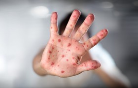 مشاهده دو مورد ابتلا به سرخک در مشهد/ افزایش عدم تمایل افراد به واکسیناسیون