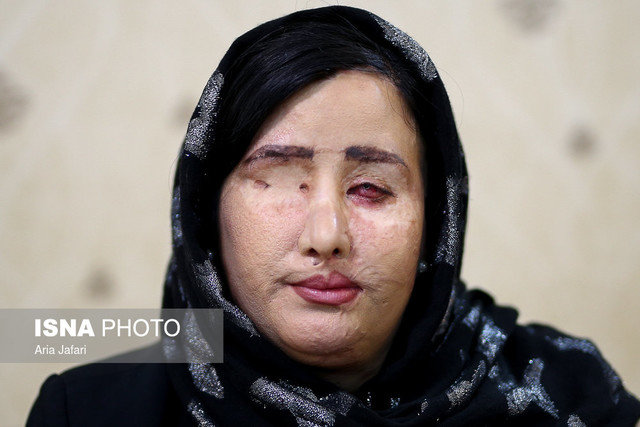 معاینه چشم سهیلا جورکش توسط وزیر بهداشت در اصفهان