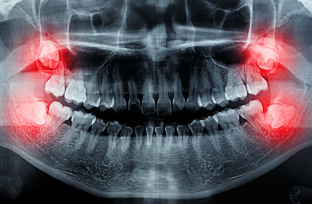 باورهای غلط در مورد دندان عقل؛ چه زمانی برای کشیدن آن اقدام کنیم؟