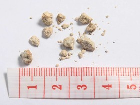 افزایش خطر ابتلا به سنگ کلیه با مصرف آنتی‌بیوتیک‌های خوراکی