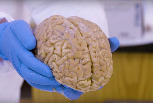 وضعیت اهدای مغز در کشورهای دیگر چگونه است؟