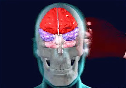 توسعه مدل مجازی مغز انسان برای تخمین آسیب‌های مغزی
