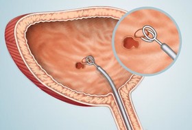 خبر شیوع بیماری سرطان مثانه به دلیل آلودگی آب کارون غیرواقعی است