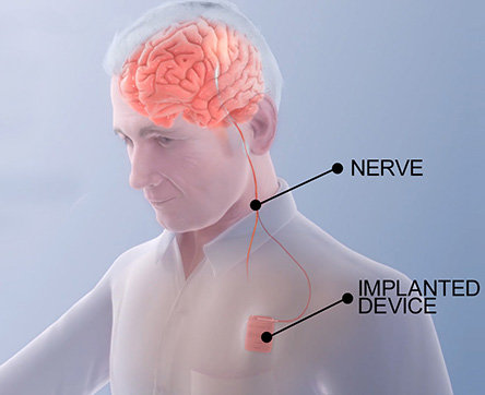 توسعه یک درمان نوین برای بهبود حرکت در بیماران سکته مغزی+فیلم
