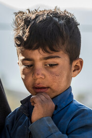 کودک ۵ ساله روستای تنگ کوره‌ای  که بدلیل نبود و عدم رعایت بهداشت گونه‌ها و‌دستان او به بیماری پوستی مبتلا شده است.