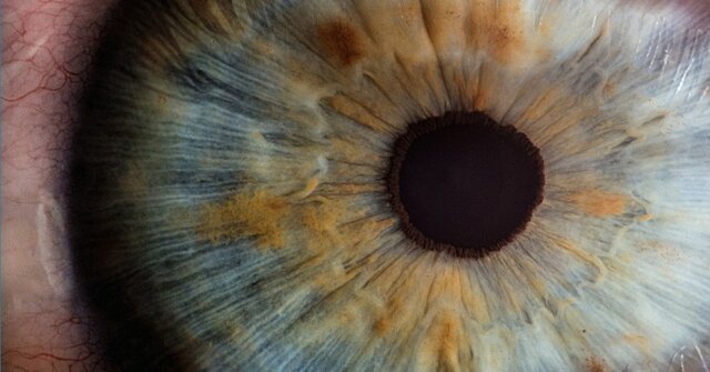 بررسی یک جهش ژنتیکی مرتبط با نوعی بیماری چشمی