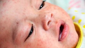 ابتلای ۳ کودک هرمزگانی به سرخک/ خانواده‌ها واکسیناسیون به‌موقع کودکان را جدی بگیرند