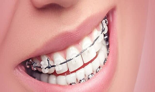 خدمات تخصصی دندانپزشکی در سال‌های اخیر بیش از گذشته مورد توجه افراد قرار...