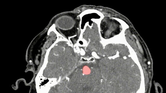 تشخیص "آنوریسم مغزی" با کمک هوش مصنوعی