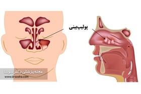 راههای درمان خانگی پولیپ بینی