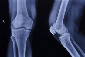 بهبود استخوان‌سازی و رگ‌زایی با استفاده از کبالت در داربست‌های ترمیم استخوان
