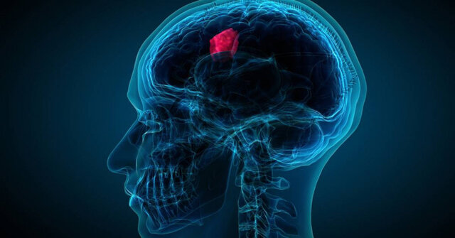 تشخیص تومور مغزی تهاجمی با یک آزمایش ساده