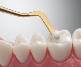 راه‌اندازی خط تولید ملی ایمپلنت دندانی