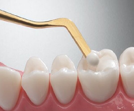 تولید نانوکامپوزیت‌های دندان نژاد ایرانی در کشور/ جلوگیری از خروج ۸ میلیون دلار ارز