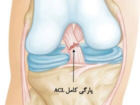 تمرینات توانبخشی پس از جراحی رباط صلیبی + عکس