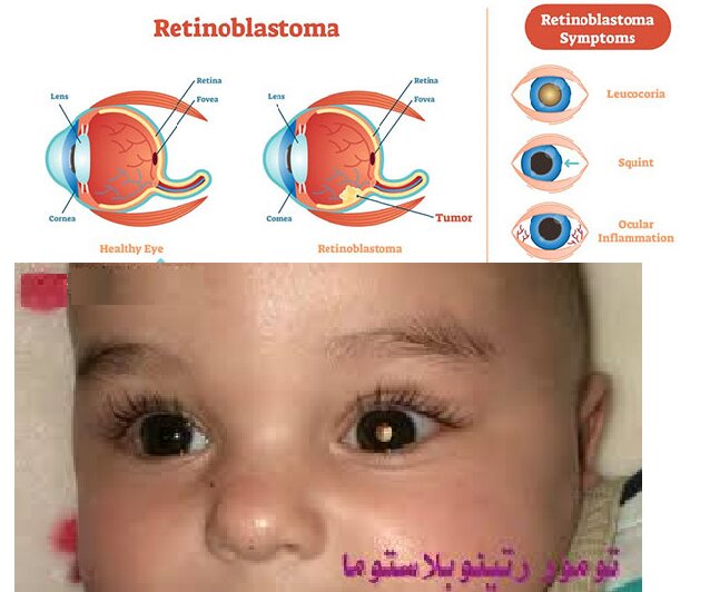 سـرطـان خـامـوش