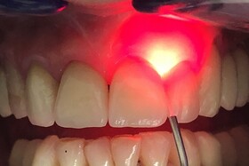 آشنایی با نحوه درمان با لیزر در دندانپزشکی