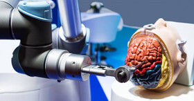 نخستین جراحی "آنوریسم مغزی" توسط ربات انجام شد