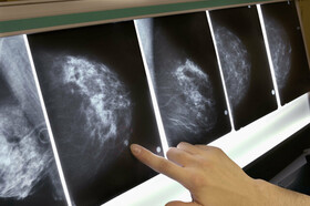 یک نفر از هر هشت زن به سرطان پستان مبتلا می‌شود