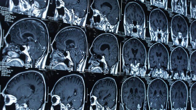 تعیین میزان آسیب‌های مغزی با هوش مصنوعی