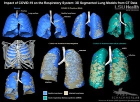شناسایی کووید- ۱۹ در ریه با کمک مدل‌های سه‌بعدی