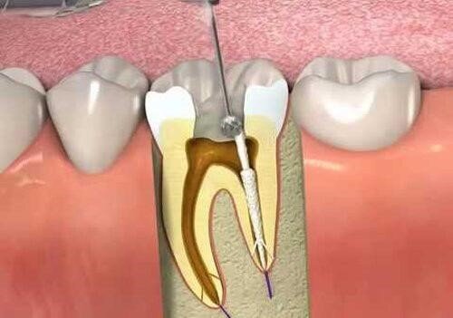 سایت پی جو مرجع معرفی دندانپزشکان متخصص پروتز و درمان ریشه دندان در ایران