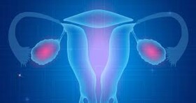 حفظ باروری در زنان دارای سرطان تخمدان