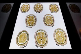 بومی سازی تجهیزات تصویربردازی مغز و بررسی جریان خون در رگ از سوی محققان کشور