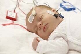 غربالگری شنوایی نوزادان از طریق پاسخ ساقه مغز
