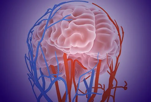 تشخیص خونریزی مغزی با کمک نرم افزار هوش مصنوعی