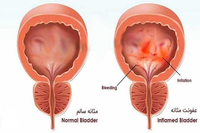 شایع ترین بیماری های مثانه 