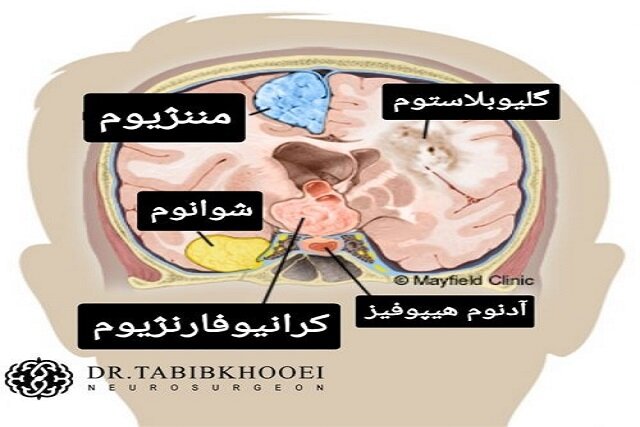 تومور مغزی چیست