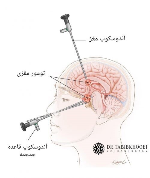 جراحی تومور مغزی