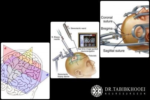 جراحی تومور مغزی