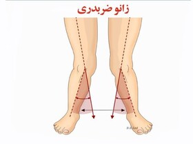 ناهنجاری زانوی ضربدری و حرکات اصلاحی آن